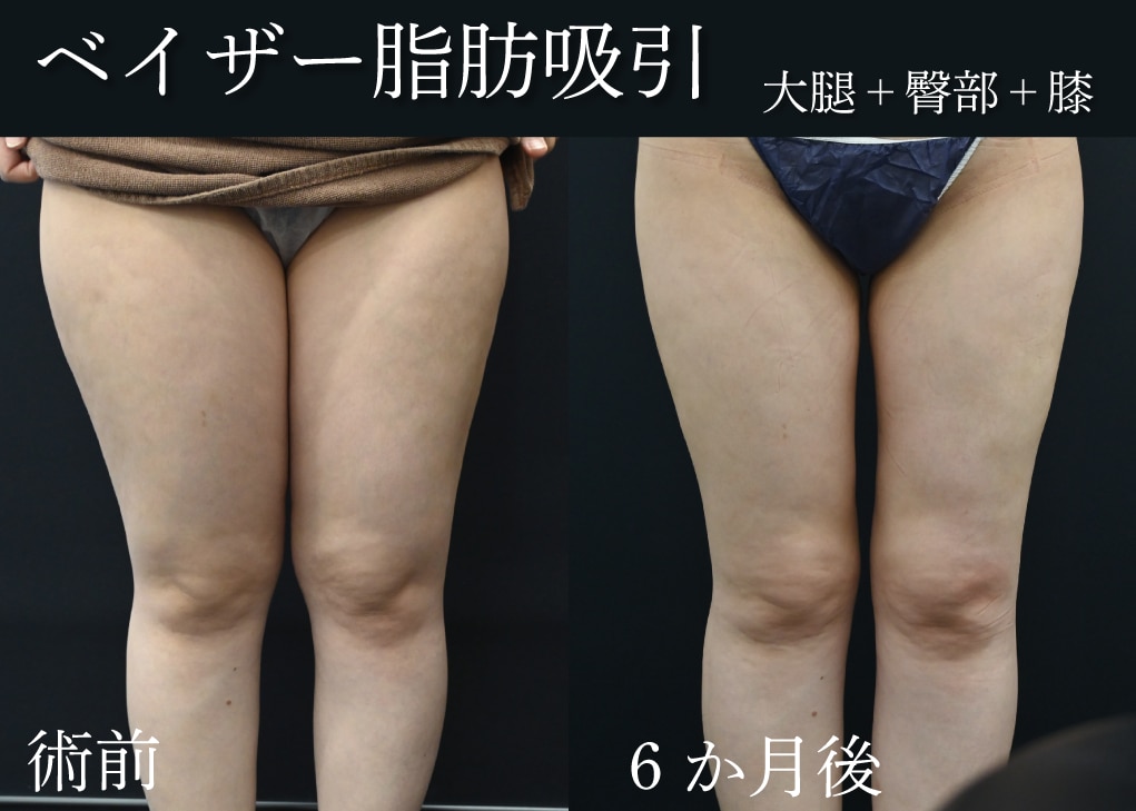 脂肪吸引の症例